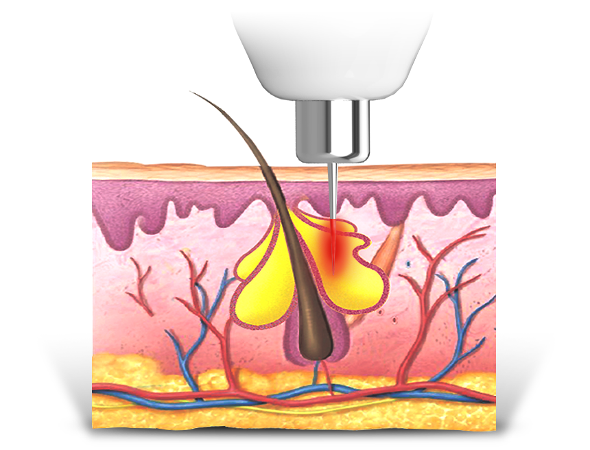 Selective sebaceous glands desruction