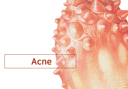 Skin Treatment Multiplayer acne