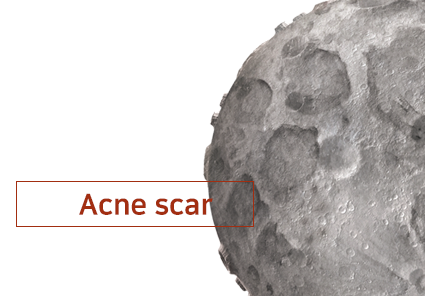 Skin Treatment Multiplayer acne scar