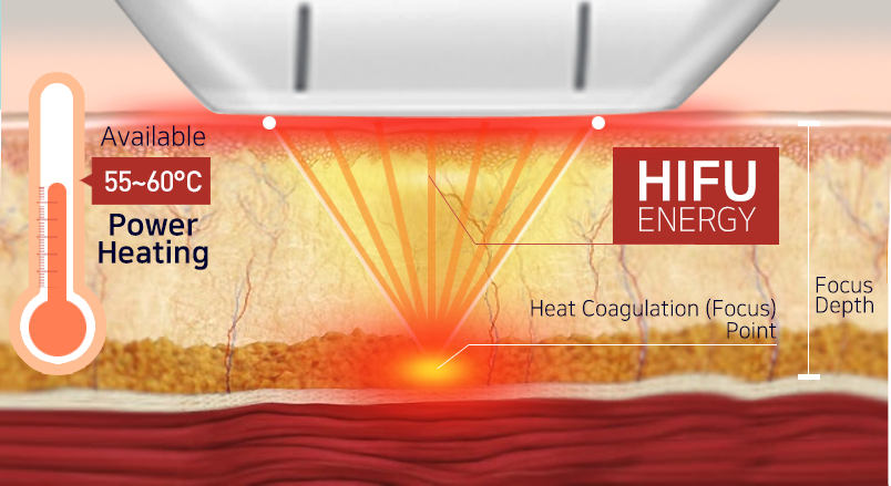 HIFU treatment theory