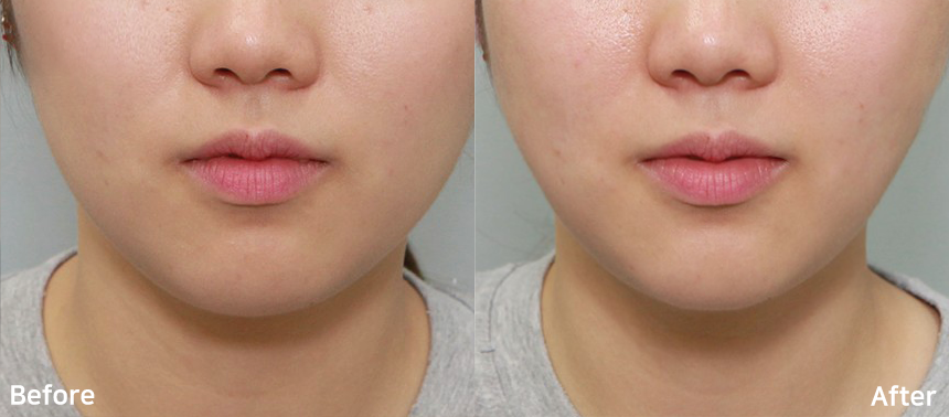 dữ liệu lâm sàng hironic