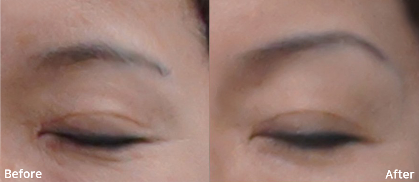 dữ liệu lâm sàng hironic