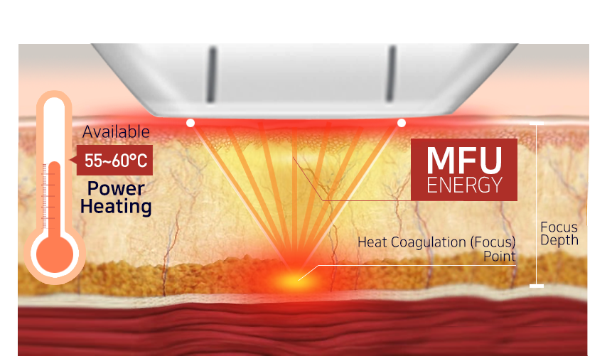 MFU treatment theory