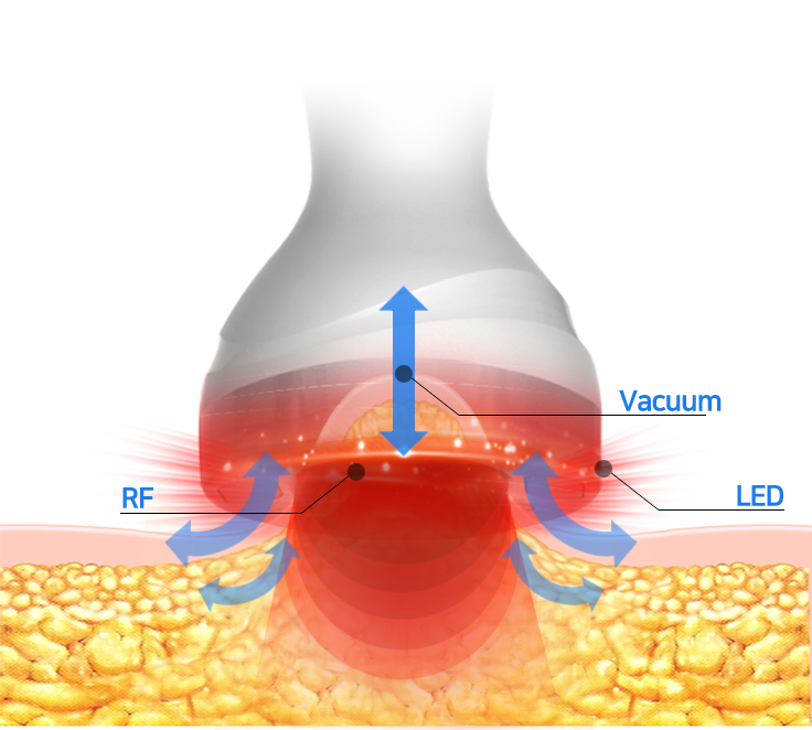 3 in 1 (RF, Vacuum, LED) Treatment to Save Time